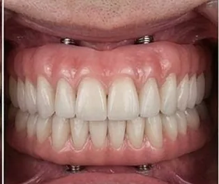 After: Anticipated full-arch dental implant result, example 1