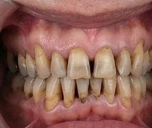 Before: Anticipated full-arch dental implant result, example 1