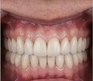 Anticipated full-arch dental implant result, example 2