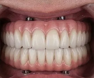 Anticipated full-arch dental implant result, example 3