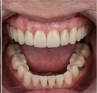 Anticipated full-arch dental implant result, example 4