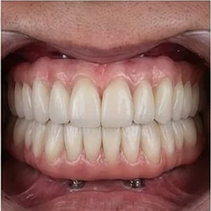 Anticipated full-arch dental implant result, example 5