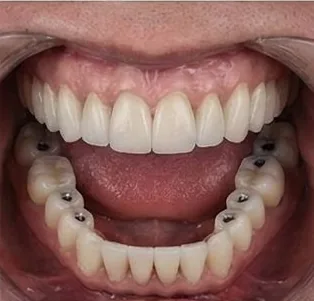 Anticipated full-arch dental implant result, example 6