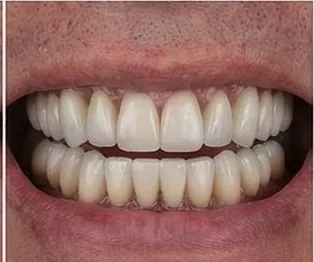 Anticipated full-arch dental implant result, example 7