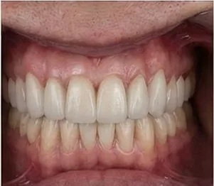 Anticipated full-arch dental implant result, example 8