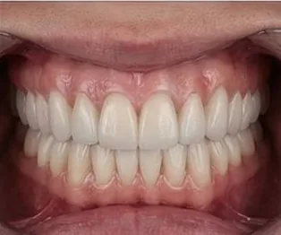Anticipated full-arch dental implant result, example 9
