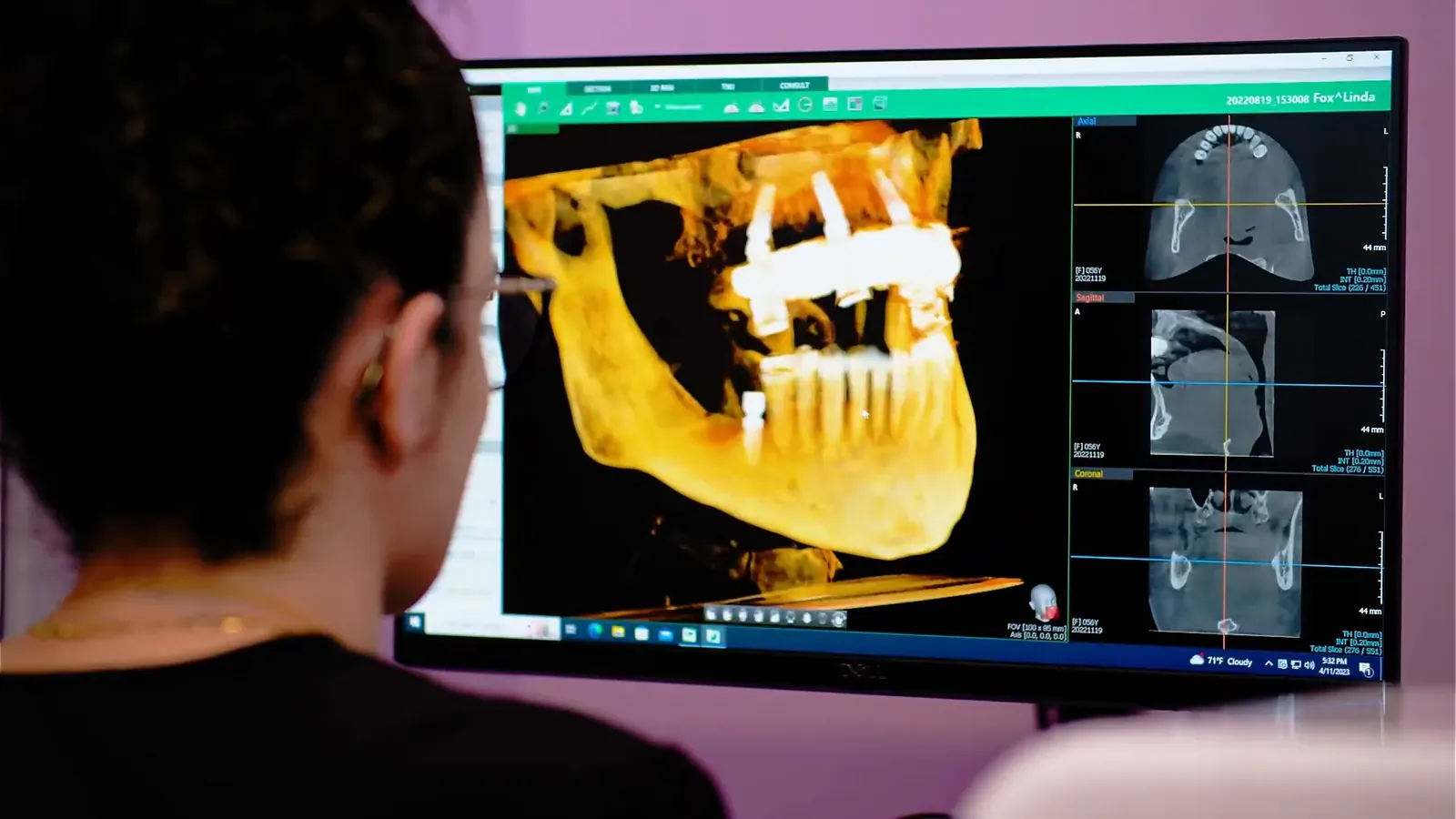 3D cone beam CT